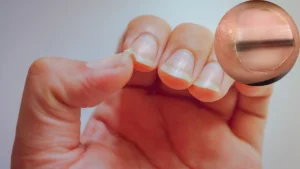6 Disturbing Things Your Nails Reveal About Your Health