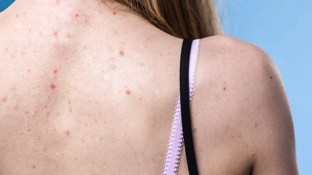 How to remove back acne: Some of the fastest ways