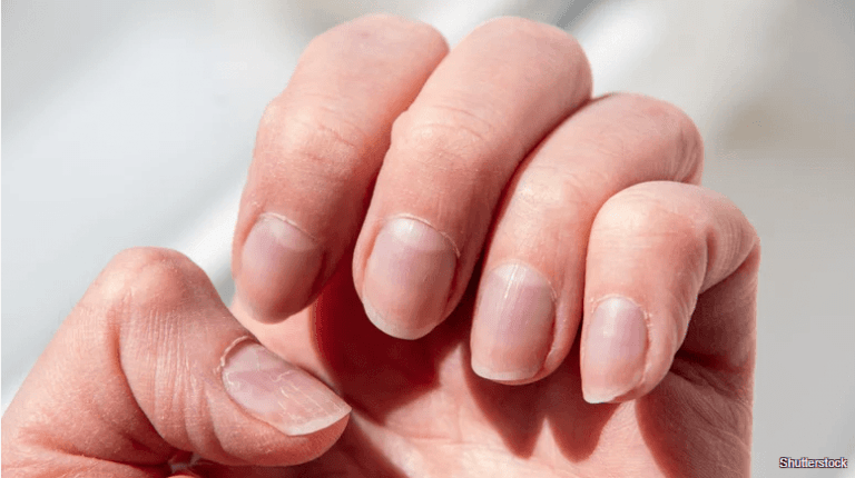 The best way to strengthen brittle nails to keep them healthy