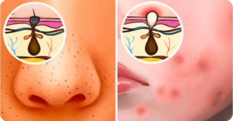 6 Types of Acne and What Might Effectuate Them