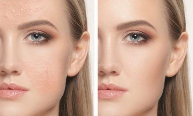 What Causes Uneven Skin Tone & How To Treat It