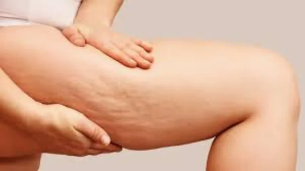Top Cellulite Fixes and Treatments