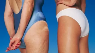 Top Cellulite Fixes and Treatments