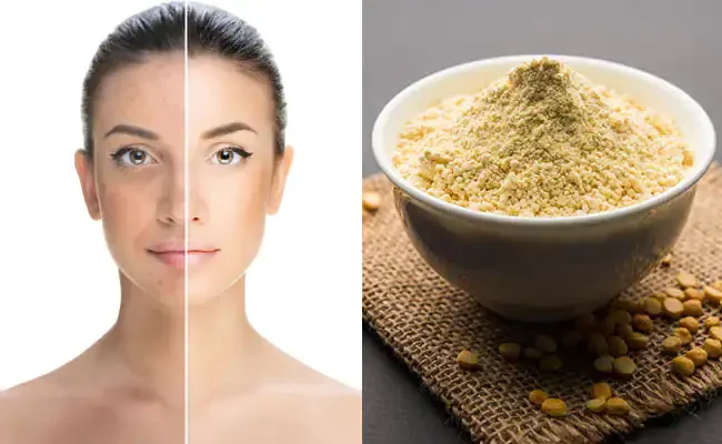 Pimples and blemishes will disappear in a few days, just mix this one thing in gram flour, then get feeding face