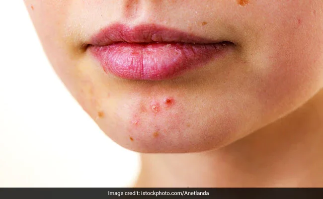 Try these home remedies to remove pimples, the problem will go away overnight and the face will bloom!