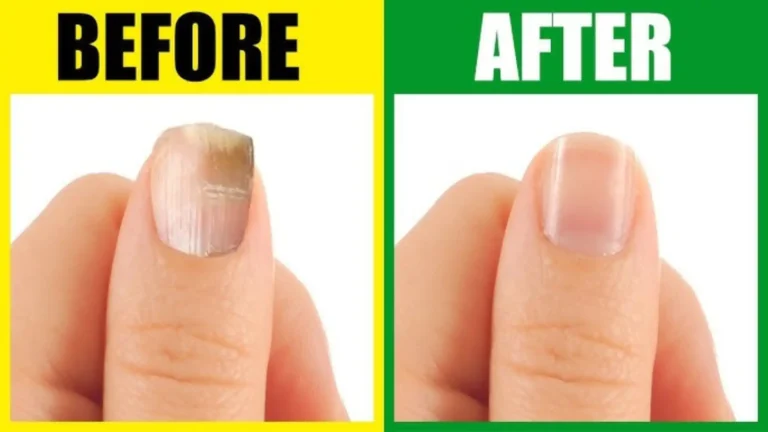 Healthzinc deficiency symptoms nail