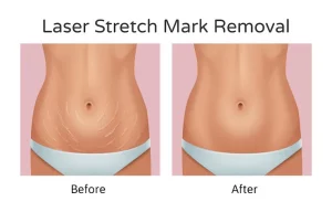 Celebrity Secrets How the Stars Remove Stretch Marks