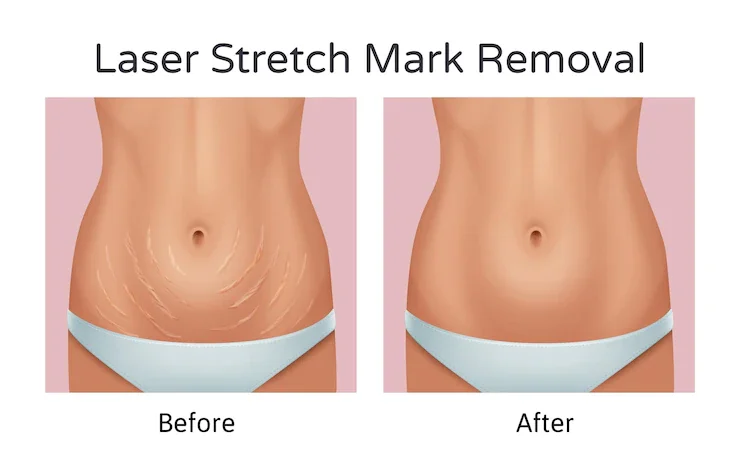 Celebrity Secrets How the Stars Remove Stretch Marks