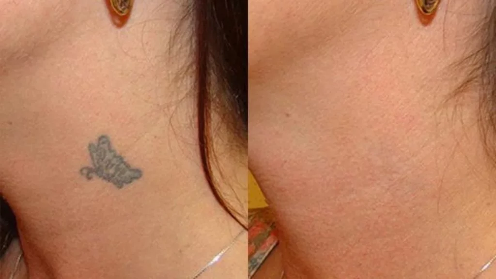 How to remove temporary tattoos without damaging your skin with makeup remover?