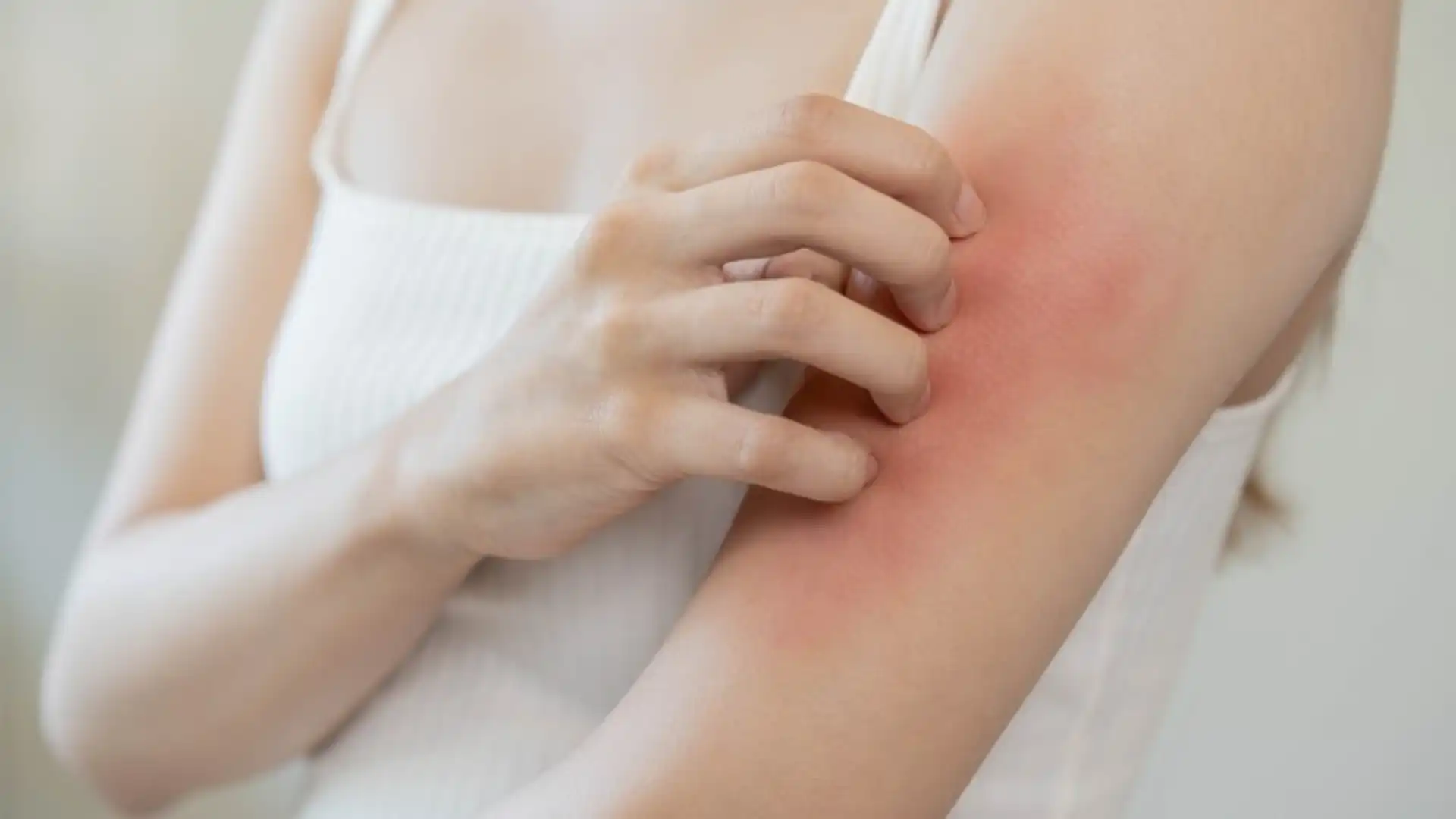 Understanding Heat Rash in Adults