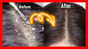 how to get rid of dandruff fast