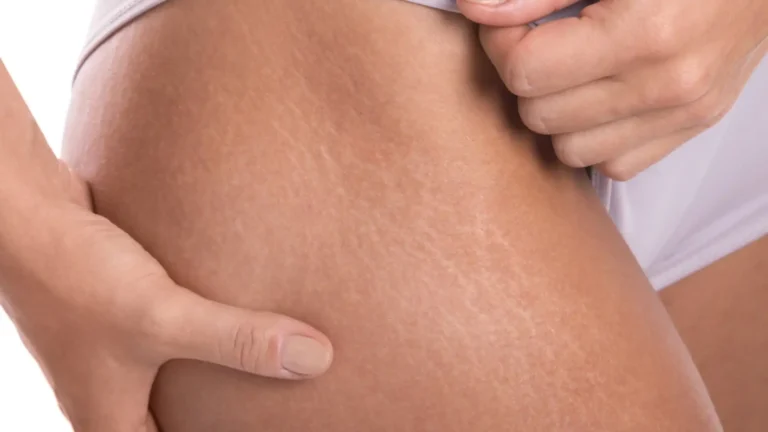 Stretch Marks: And How to Get Rid of Them - Why Do They Appear