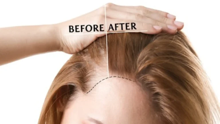 Alopecia Areata