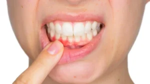 10 Expert Tips to Treat Bleeding Gums Naturally at Home