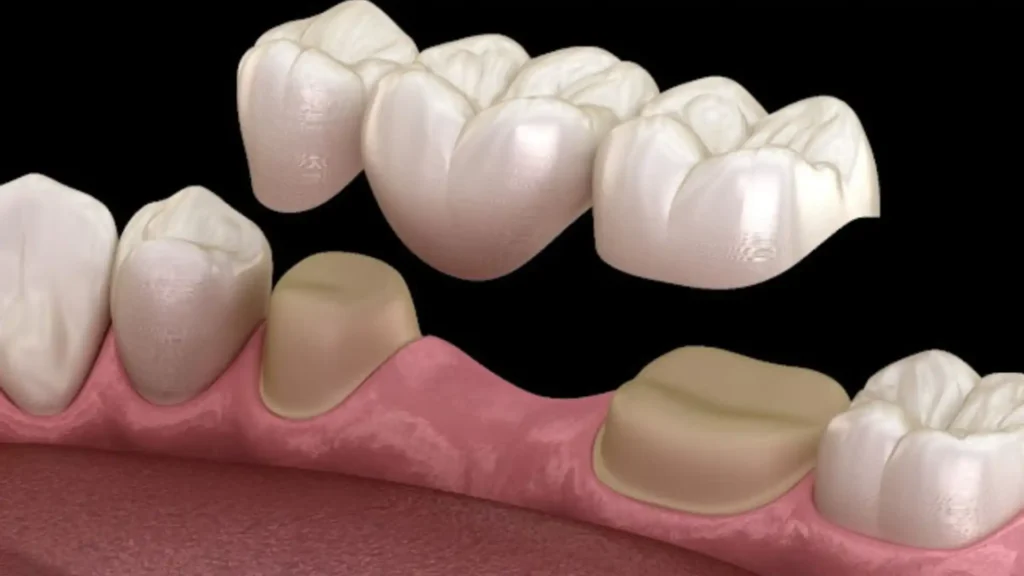 Dental Bridges: What You Need to Know