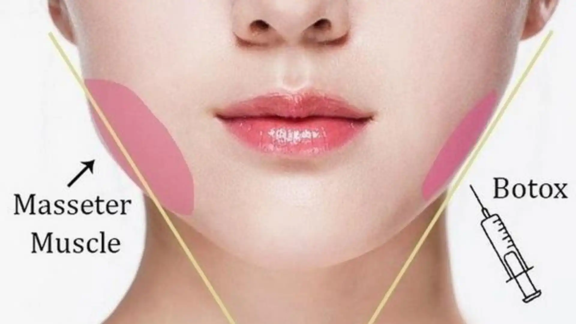 Find Safe & Effective Botox Near Me | Expert Injectors