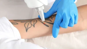 Tattoo Removal Before and After Results You Can Trust