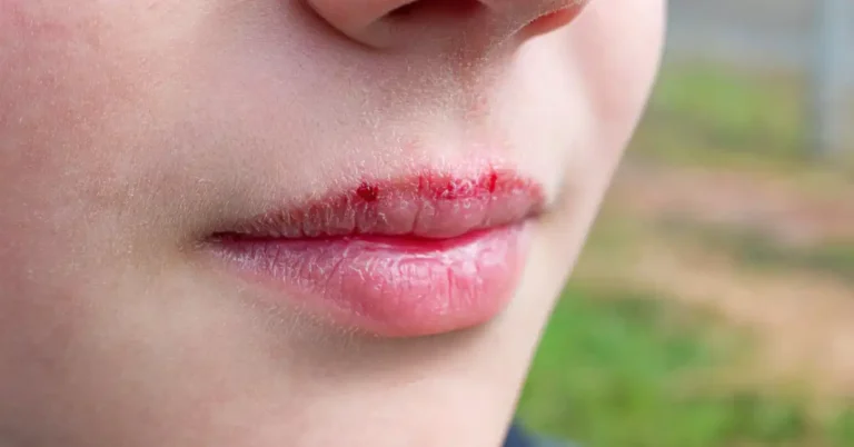 Sunburned lips