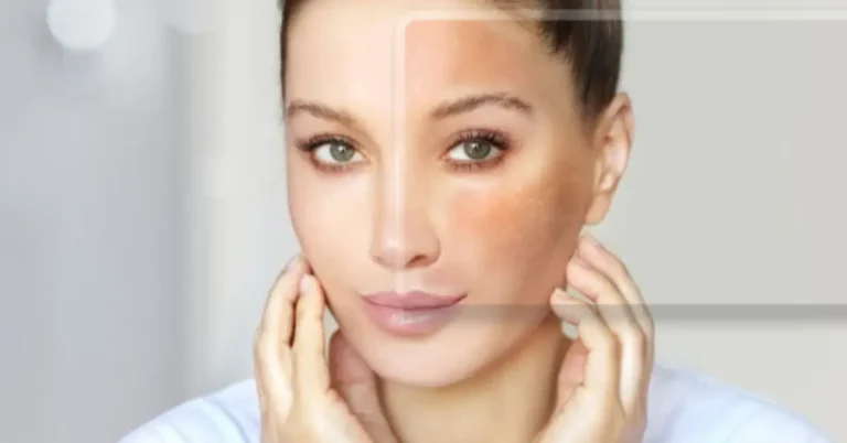best treatment for melasma on face