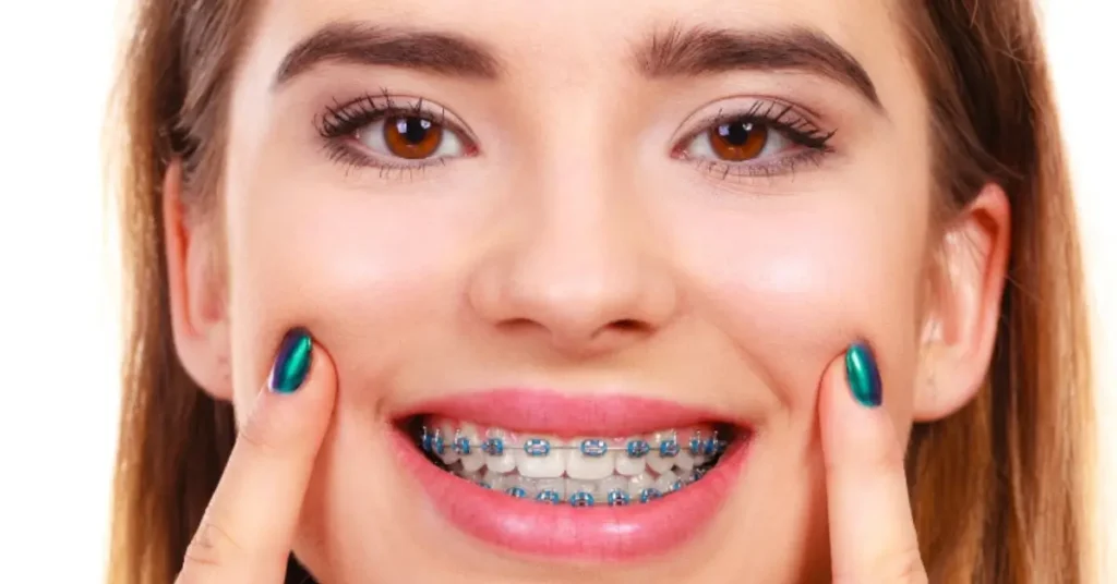 ceramic braces